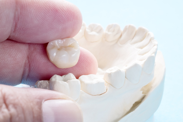 How Many Years Do Dental Crowns Last On Average?